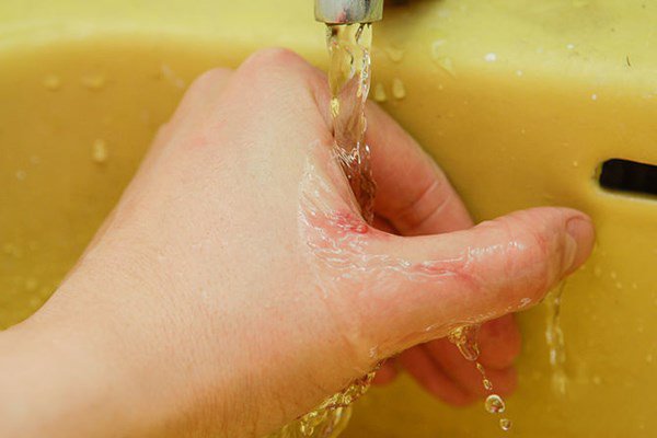 Ứng dụng của ozone trong sát trùng vết thương